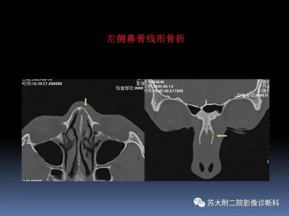 影像PPT - 【PPT】鼻骨骨折影像诊断误区-25