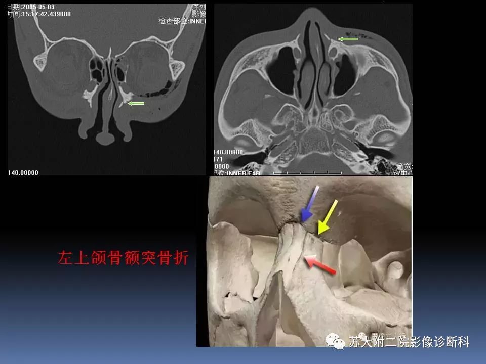 影像PPT - 【PPT】鼻骨骨折影像诊断误区-27