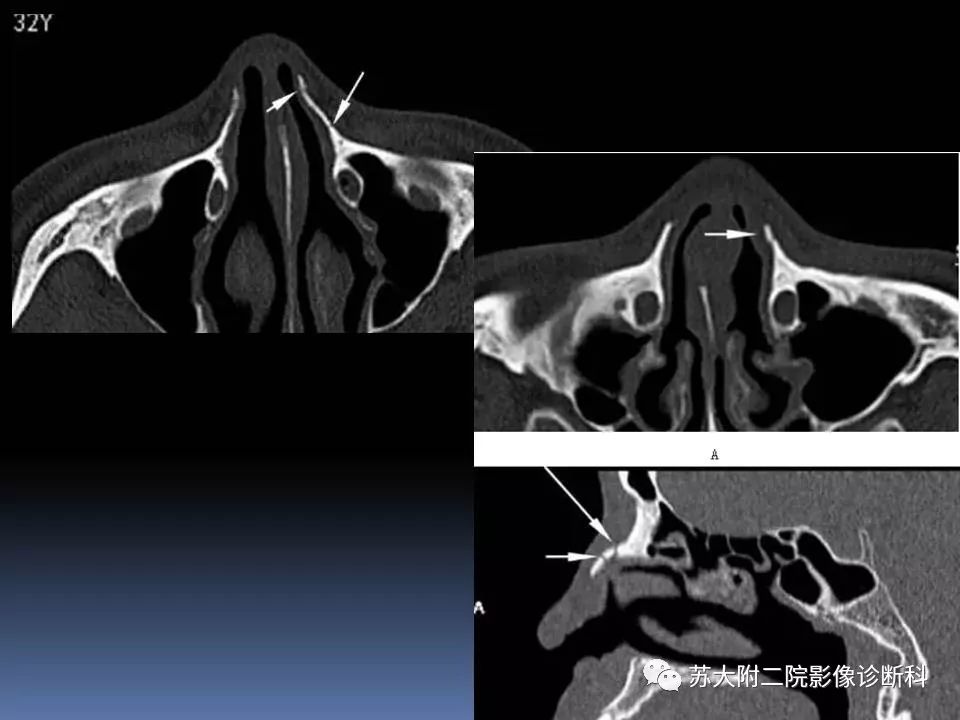 影像PPT - 【PPT】鼻骨骨折影像诊断误区-28