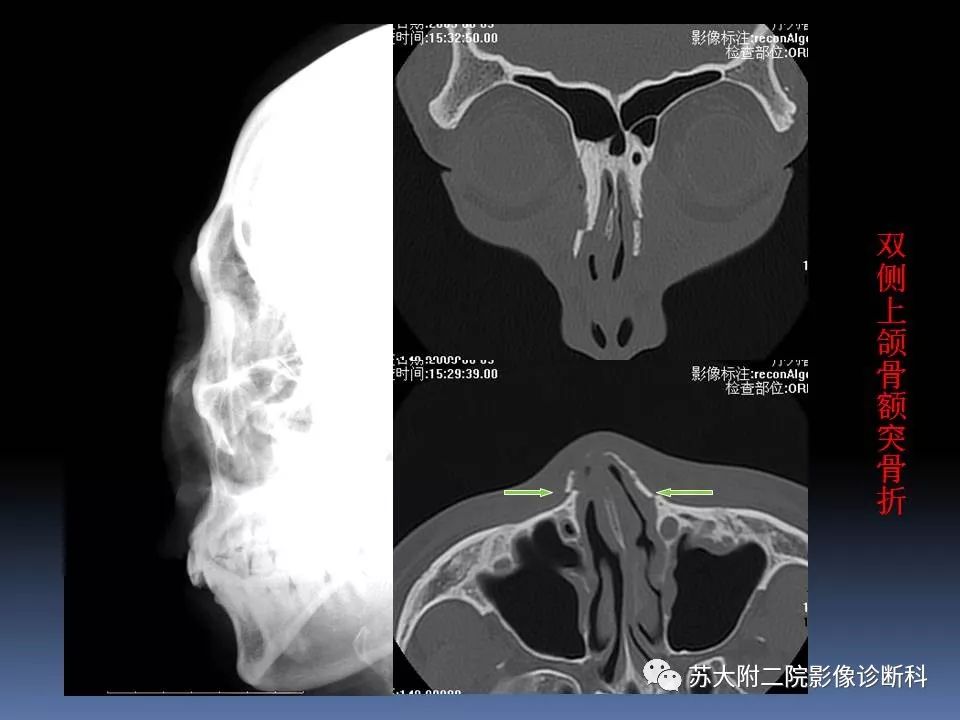 影像PPT - 【PPT】鼻骨骨折影像诊断误区-29