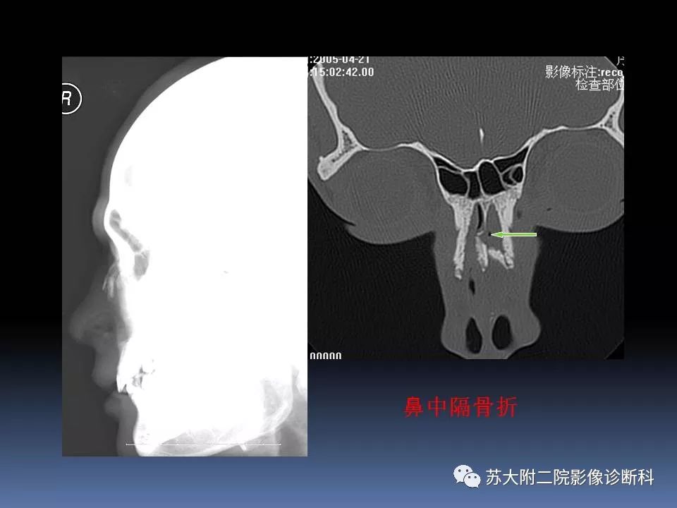 影像PPT - 【PPT】鼻骨骨折影像诊断误区-30