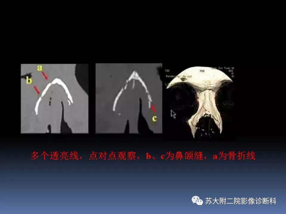 影像PPT - 【PPT】鼻骨骨折影像诊断误区-31