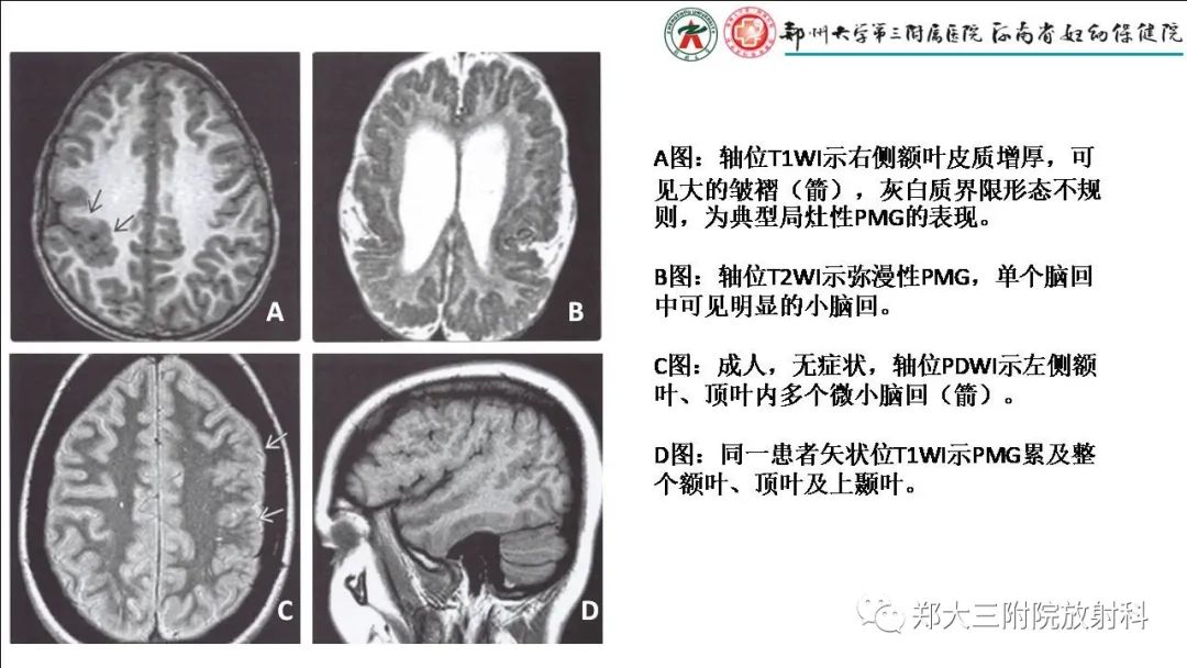 影像PPT - 【PPT】多小脑回畸形的影像表现-9