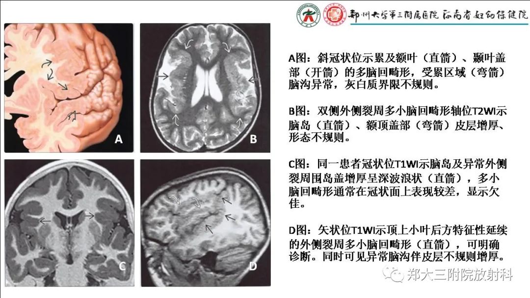 影像PPT - 【PPT】多小脑回畸形的影像表现-8