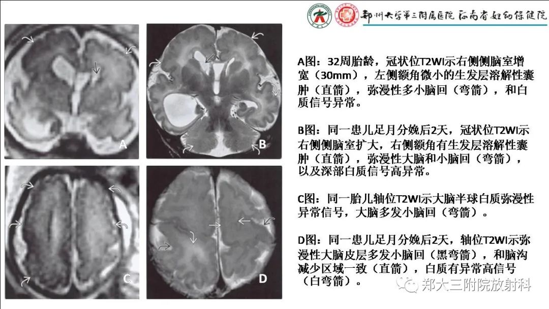 影像PPT - 【PPT】多小脑回畸形的影像表现-17