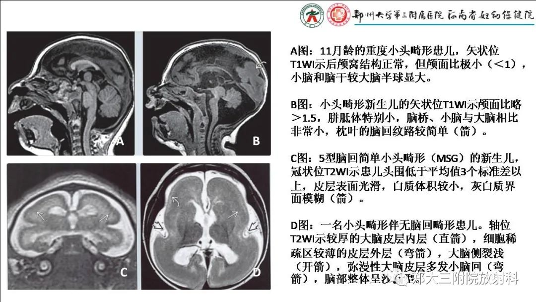 影像PPT - 【PPT】多小脑回畸形的影像表现-20