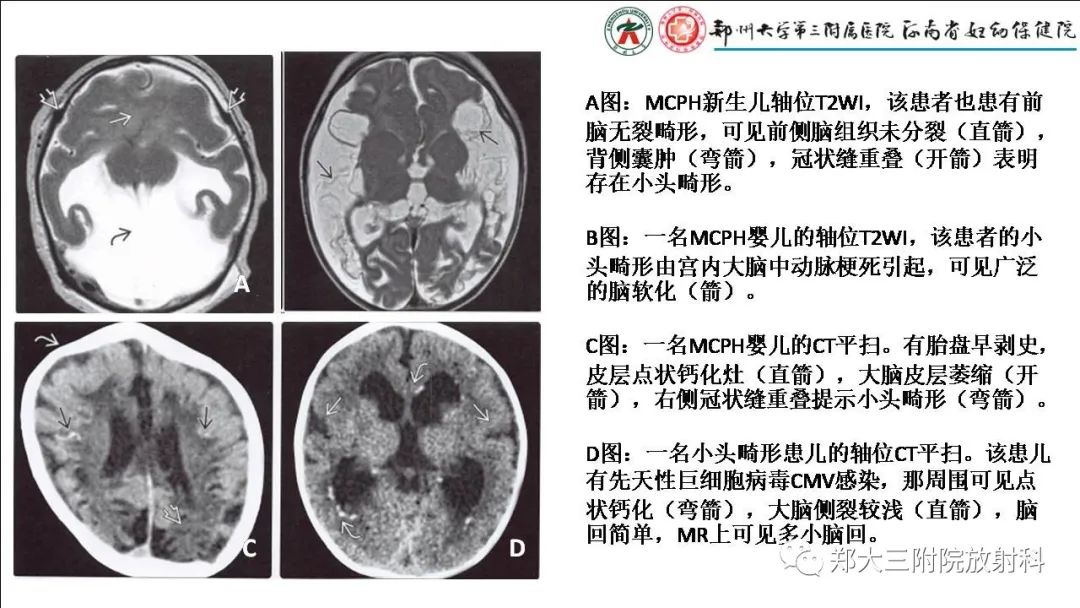 影像PPT - 【PPT】多小脑回畸形的影像表现-21
