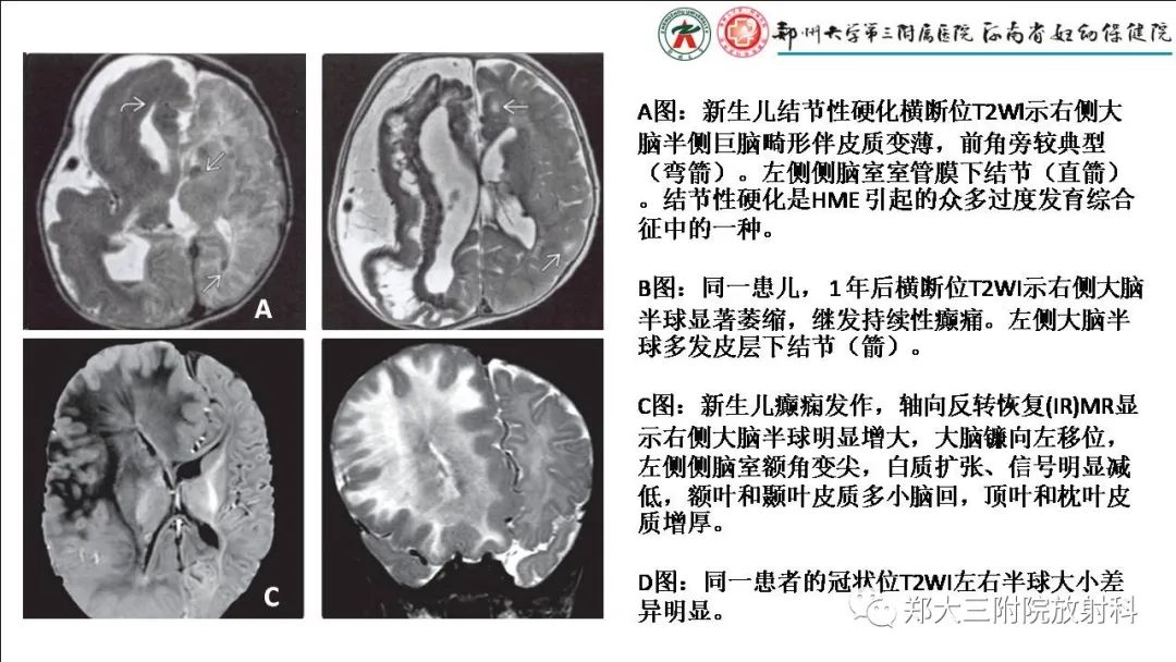 影像PPT - 【PPT】多小脑回畸形的影像表现-24