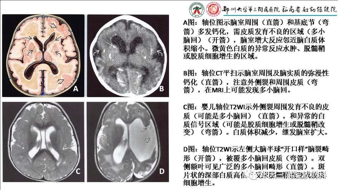 影像PPT - 【PPT】多小脑回畸形的影像表现-27