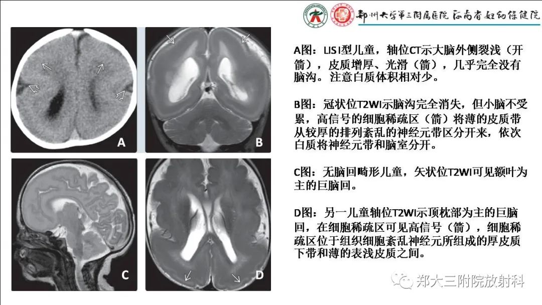 影像PPT - 【PPT】多小脑回畸形的影像表现-29