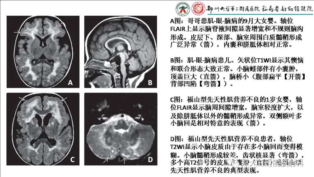 影像PPT - 【PPT】多小脑回畸形的影像表现-32