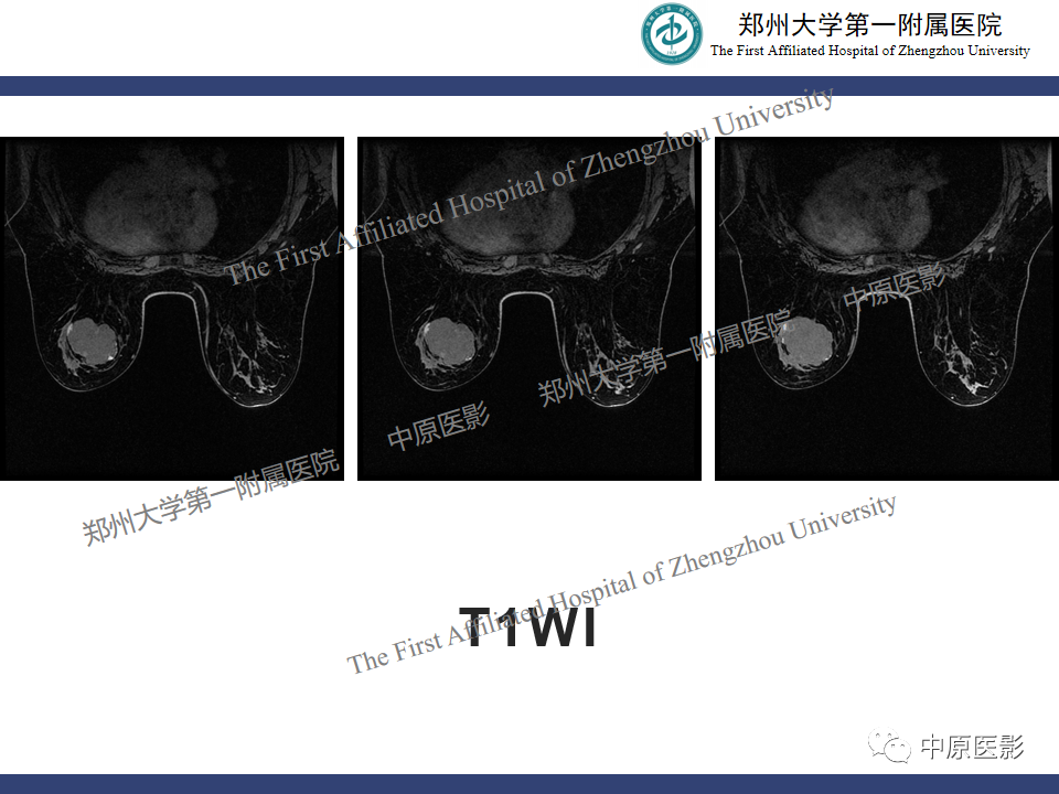 影像PPT - 【病例】乳腺交界性叶状肿瘤1例影像-3