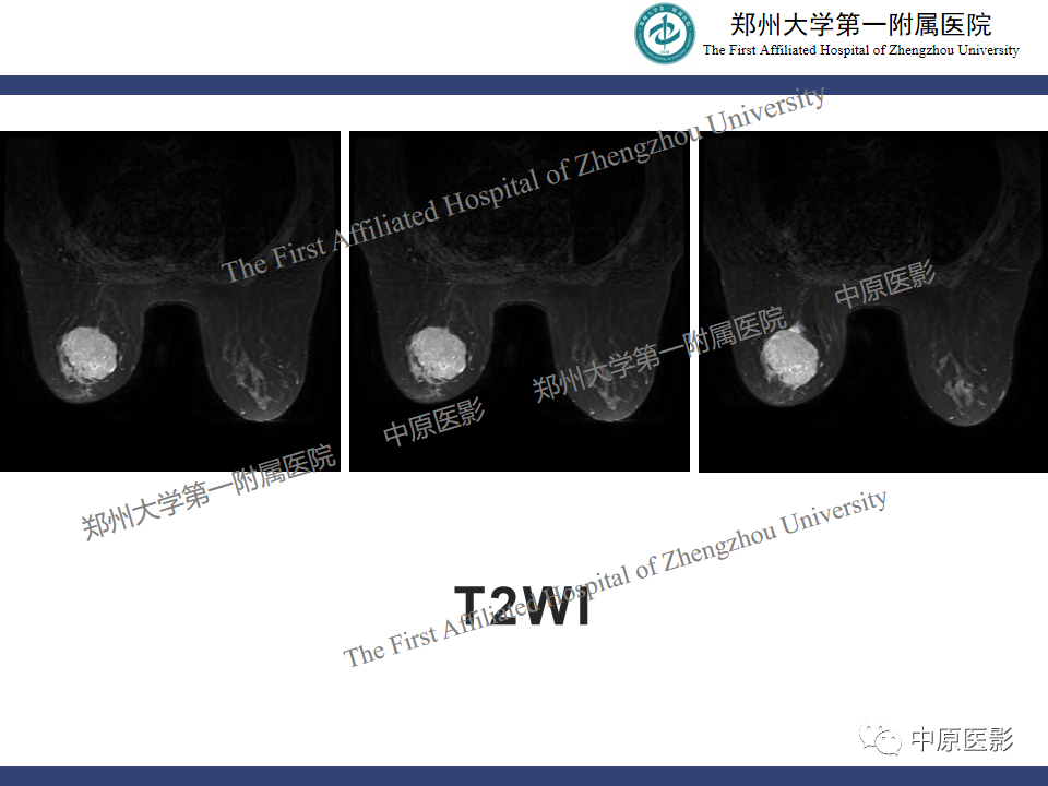 影像PPT - 【病例】乳腺交界性叶状肿瘤1例影像-4