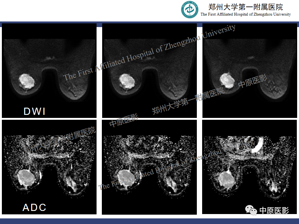 影像PPT - 【病例】乳腺交界性叶状肿瘤1例影像-5