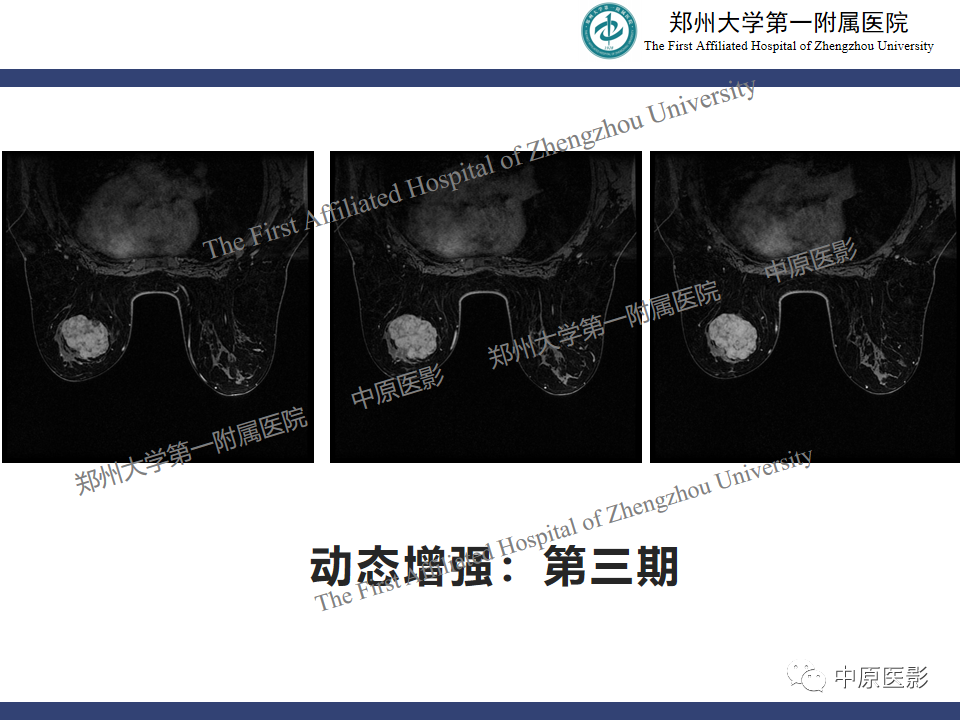 影像PPT - 【病例】乳腺交界性叶状肿瘤1例影像-7