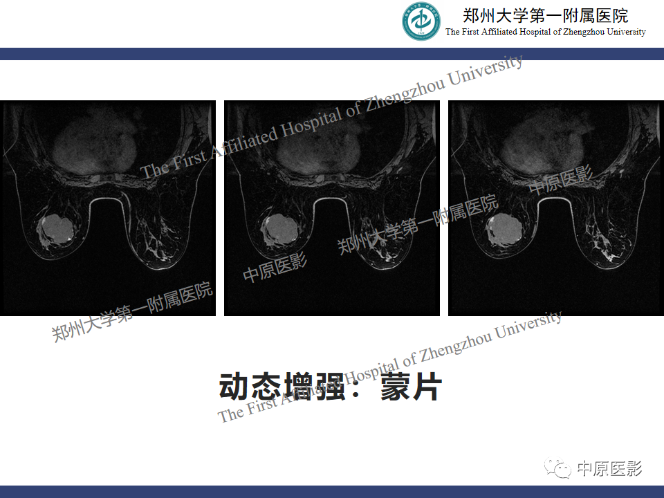 影像PPT - 【病例】乳腺交界性叶状肿瘤1例影像-6