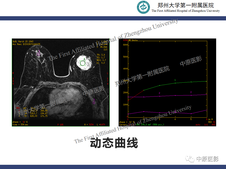 影像PPT - 【病例】乳腺交界性叶状肿瘤1例影像-9