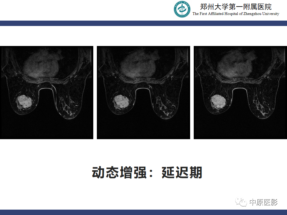 影像PPT - 【病例】乳腺交界性叶状肿瘤1例影像-8