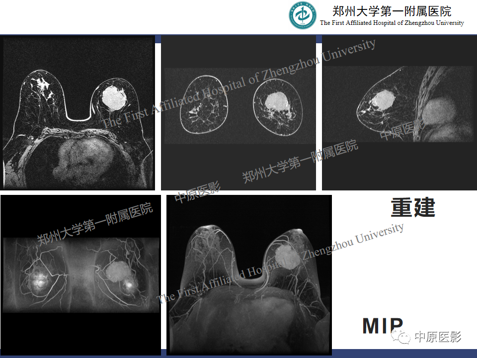 影像PPT - 【病例】乳腺交界性叶状肿瘤1例影像-10