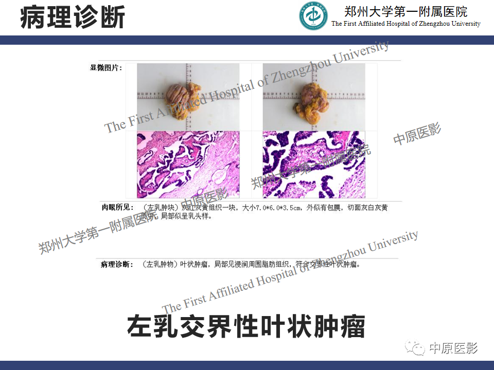 影像PPT - 【病例】乳腺交界性叶状肿瘤1例影像-13