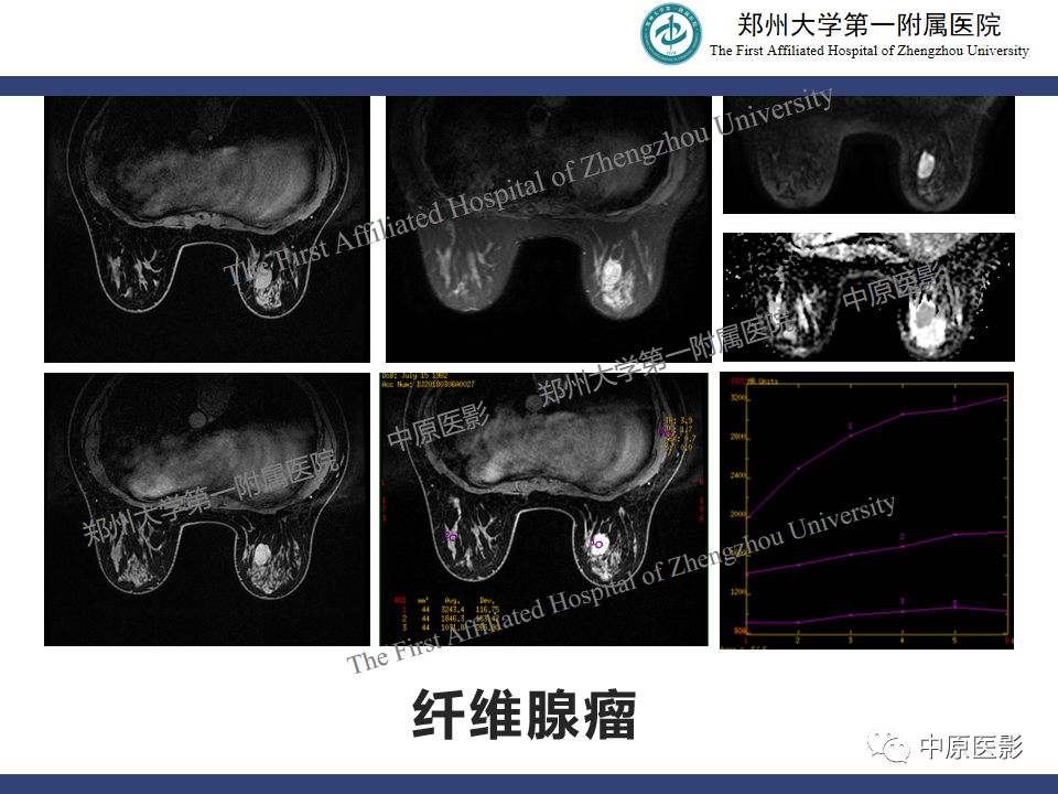 影像PPT - 【病例】乳腺交界性叶状肿瘤1例影像-19