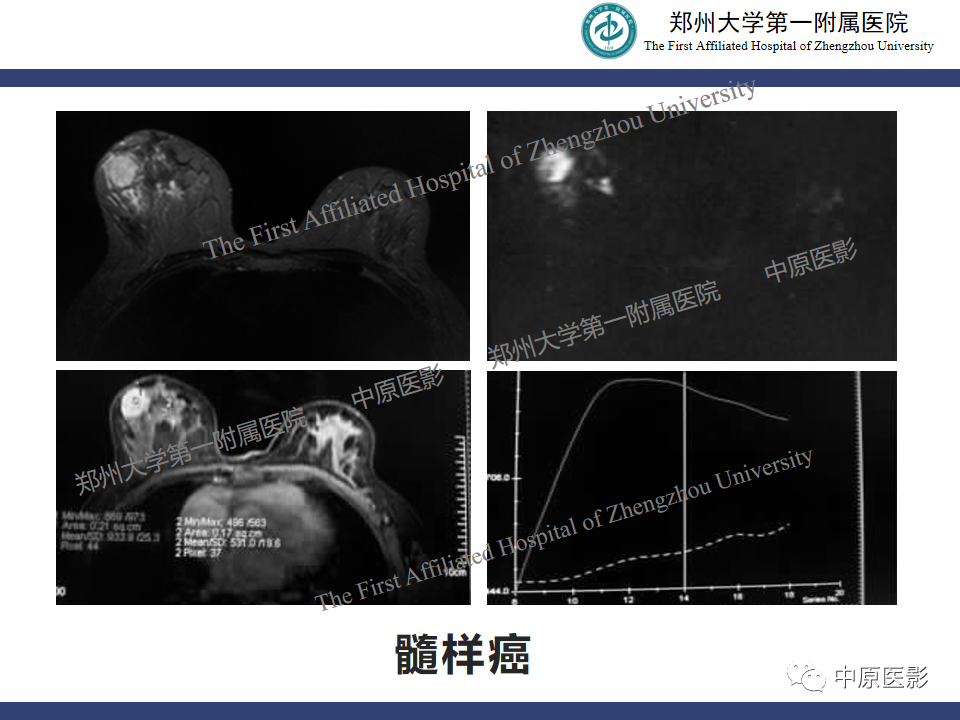 影像PPT - 【病例】乳腺交界性叶状肿瘤1例影像-21
