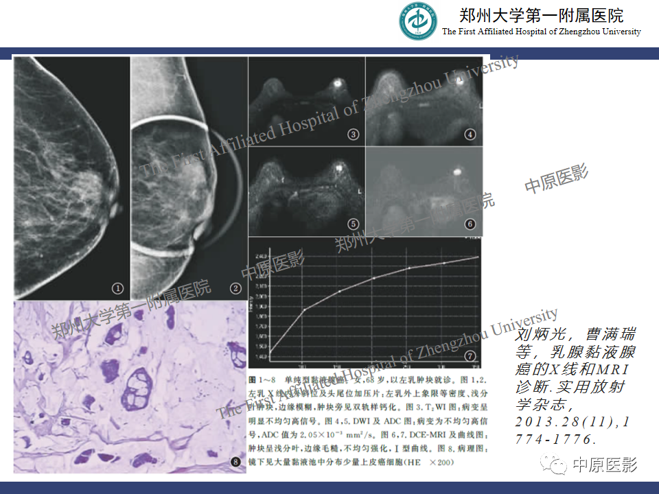 影像PPT - 【病例】乳腺交界性叶状肿瘤1例影像-24
