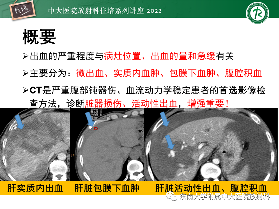 影像PPT - 【PPT】肝脏出血性病变的影像诊断及鉴别诊断-2