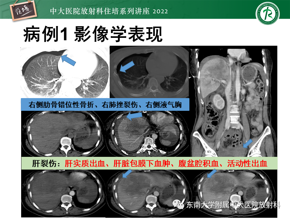 影像PPT - 【PPT】肝脏出血性病变的影像诊断及鉴别诊断-5