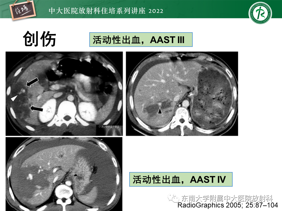 影像PPT - 【PPT】肝脏出血性病变的影像诊断及鉴别诊断-11