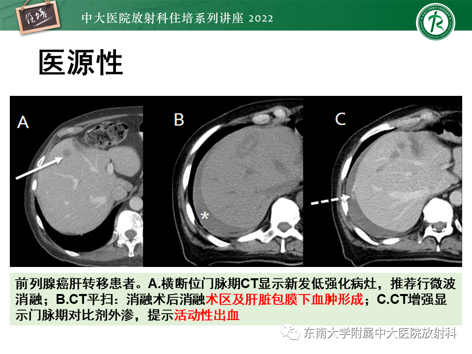 影像PPT - 【PPT】肝脏出血性病变的影像诊断及鉴别诊断-14