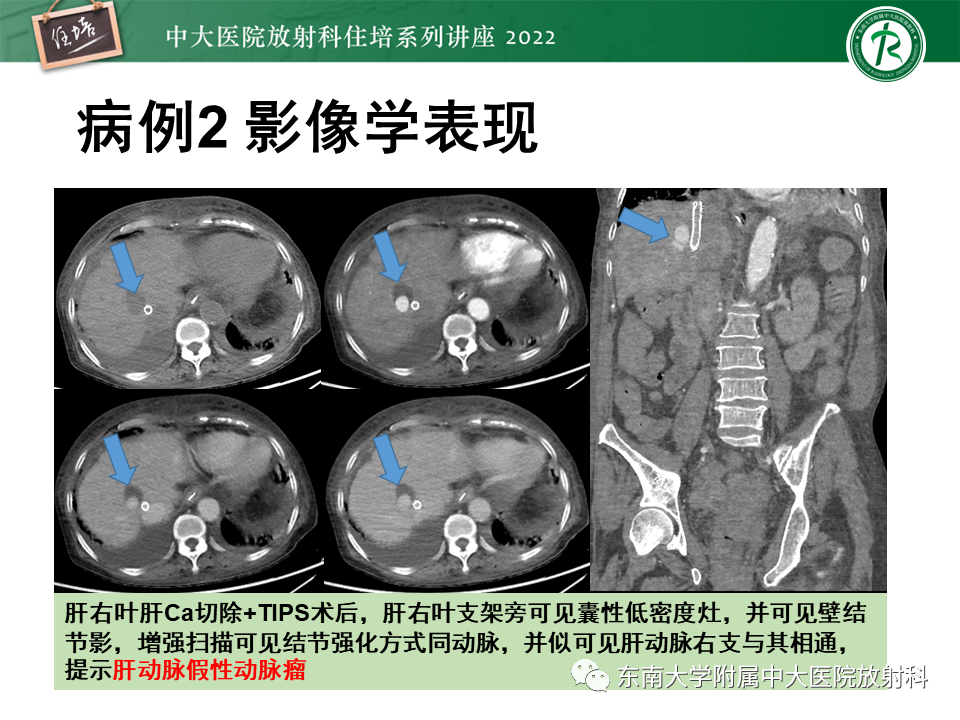 影像PPT - 【PPT】肝脏出血性病变的影像诊断及鉴别诊断-15