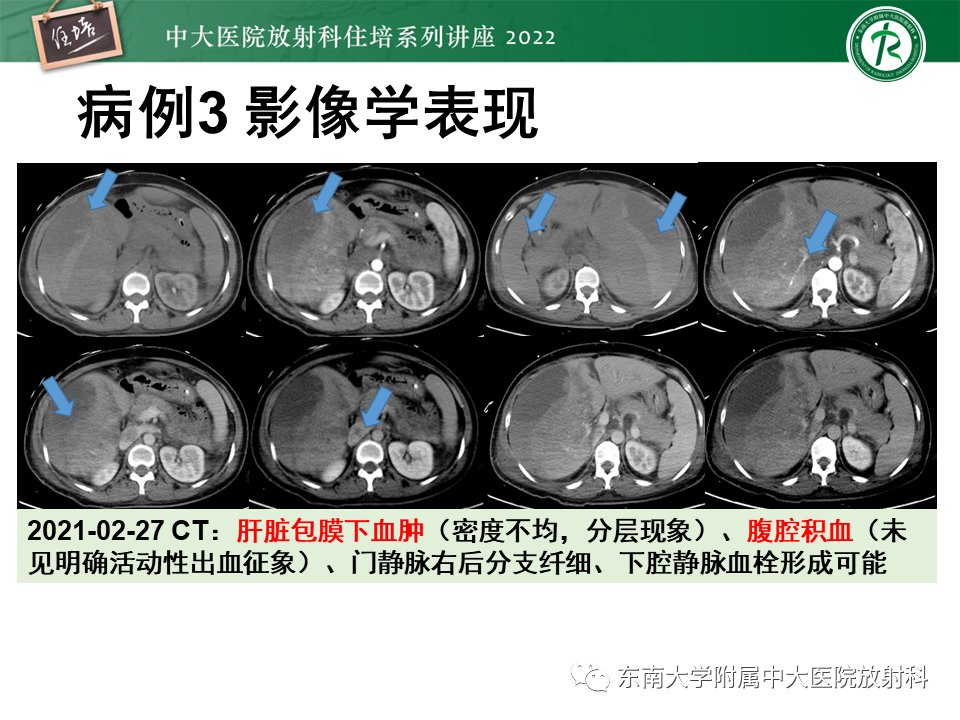 影像PPT - 【PPT】肝脏出血性病变的影像诊断及鉴别诊断-18