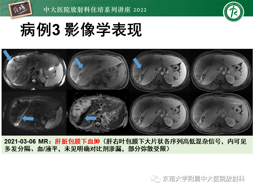 影像PPT - 【PPT】肝脏出血性病变的影像诊断及鉴别诊断-19