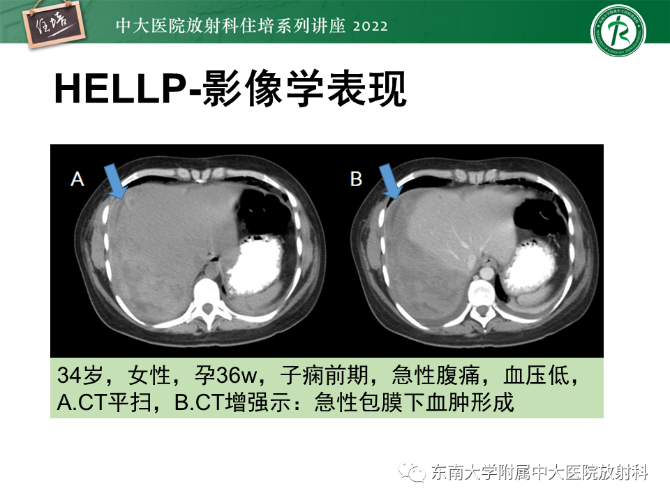 影像PPT - 【PPT】肝脏出血性病变的影像诊断及鉴别诊断-23