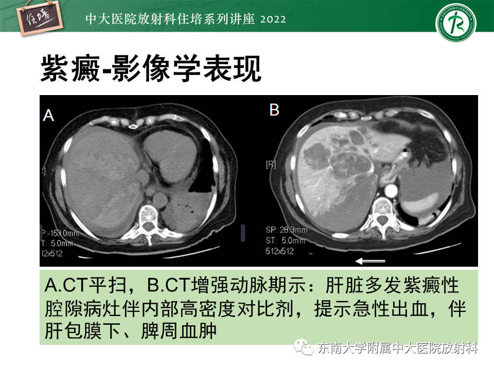 影像PPT - 【PPT】肝脏出血性病变的影像诊断及鉴别诊断-26