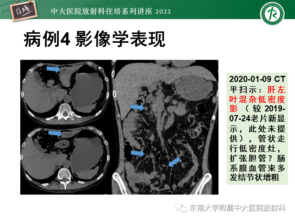 影像PPT - 【PPT】肝脏出血性病变的影像诊断及鉴别诊断-29
