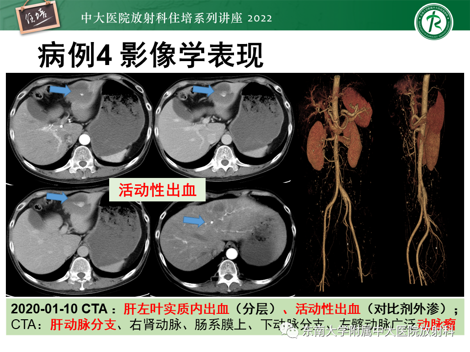 影像PPT - 【PPT】肝脏出血性病变的影像诊断及鉴别诊断-30
