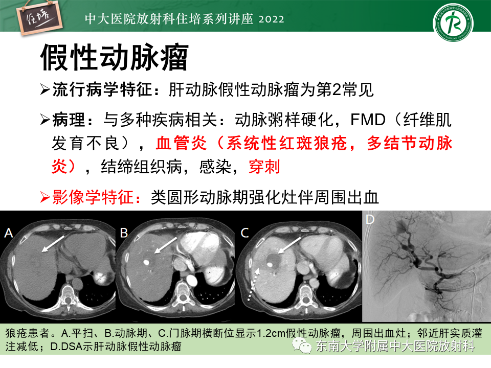 影像PPT - 【PPT】肝脏出血性病变的影像诊断及鉴别诊断-34