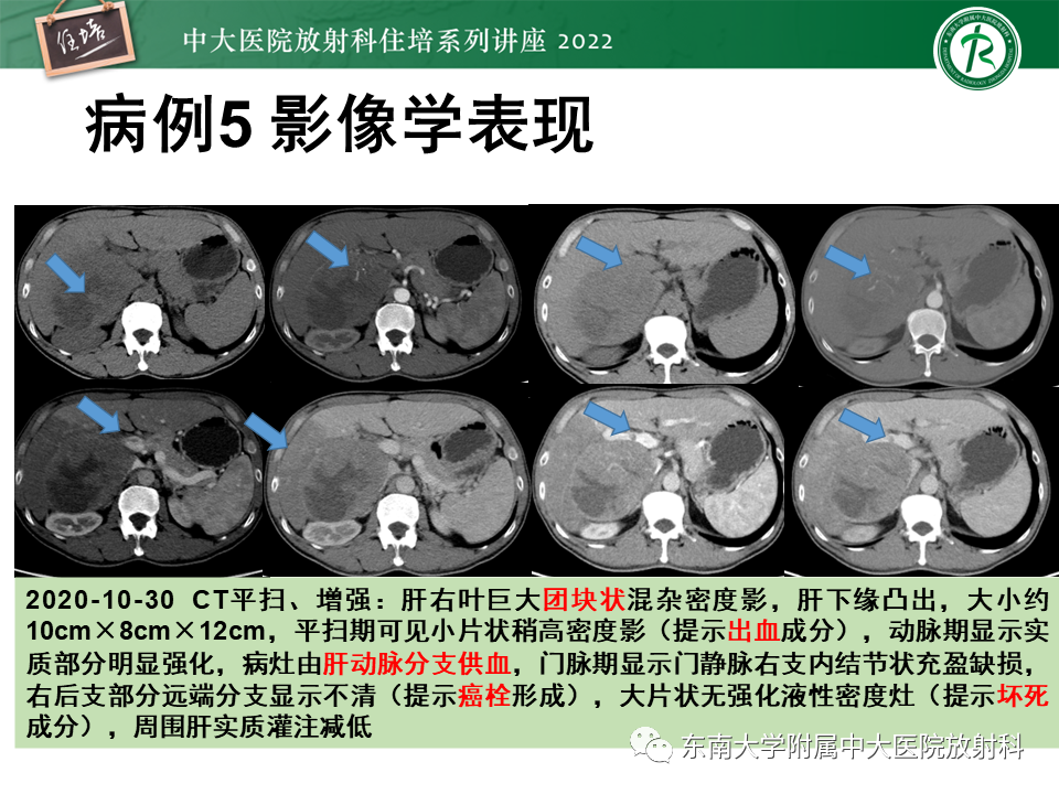 影像PPT - 【PPT】肝脏出血性病变的影像诊断及鉴别诊断-36