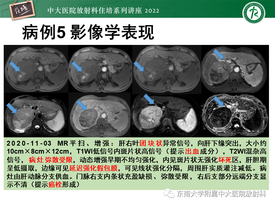 影像PPT - 【PPT】肝脏出血性病变的影像诊断及鉴别诊断-37