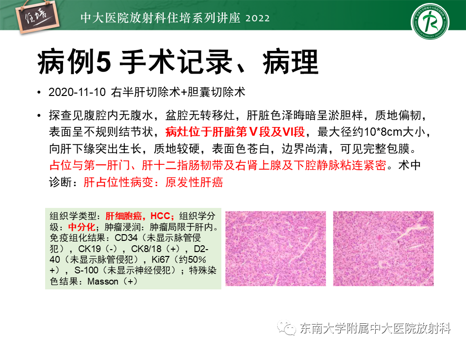 影像PPT - 【PPT】肝脏出血性病变的影像诊断及鉴别诊断-38