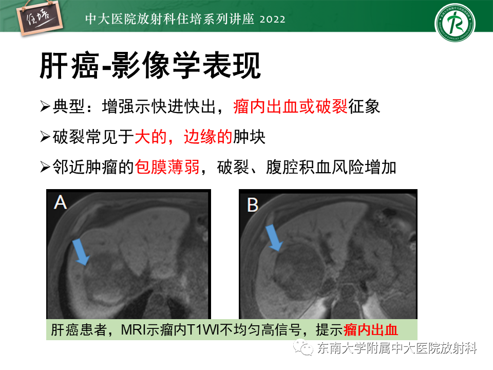 影像PPT - 【PPT】肝脏出血性病变的影像诊断及鉴别诊断-42