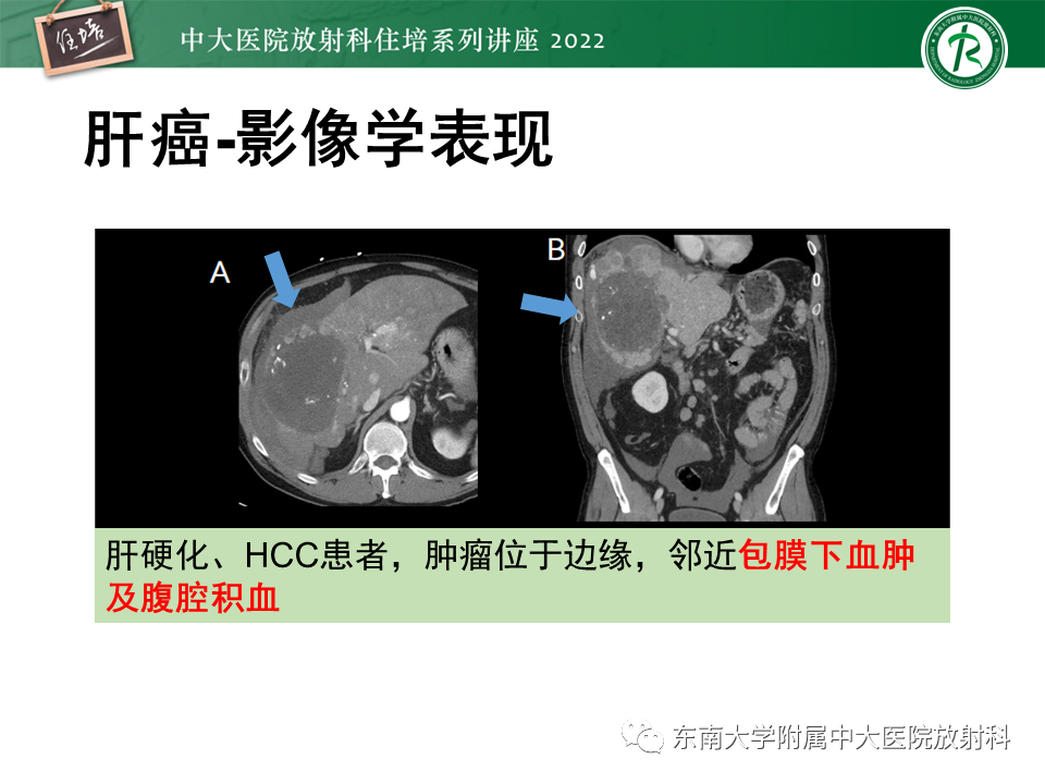 影像PPT - 【PPT】肝脏出血性病变的影像诊断及鉴别诊断-43