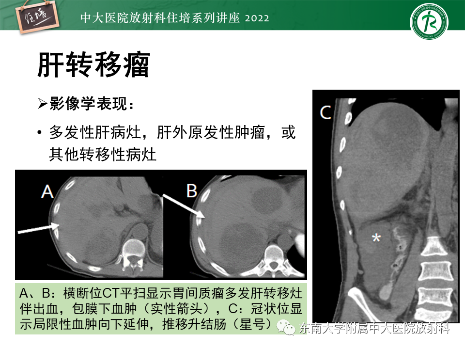 影像PPT - 【PPT】肝脏出血性病变的影像诊断及鉴别诊断-46