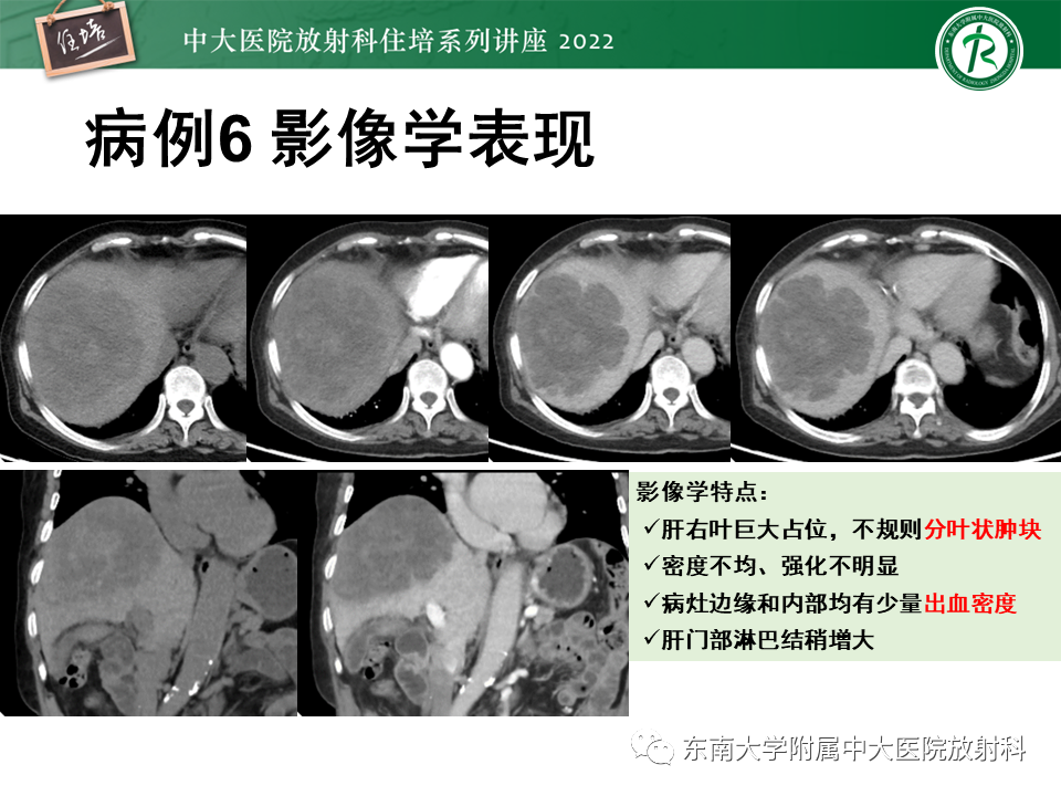 影像PPT - 【PPT】肝脏出血性病变的影像诊断及鉴别诊断-48
