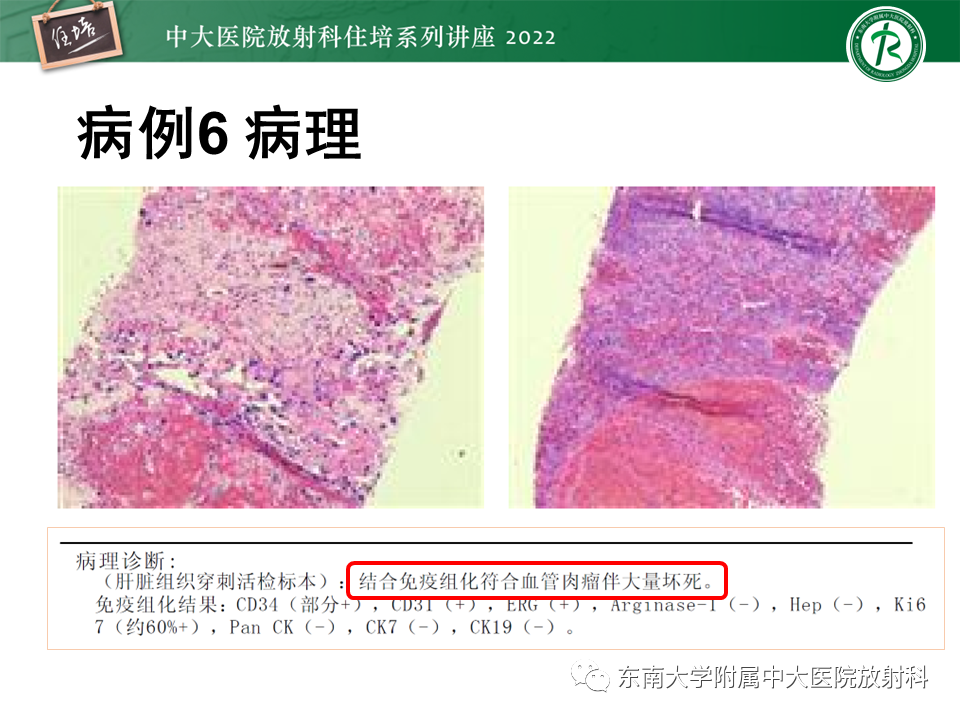 影像PPT - 【PPT】肝脏出血性病变的影像诊断及鉴别诊断-49