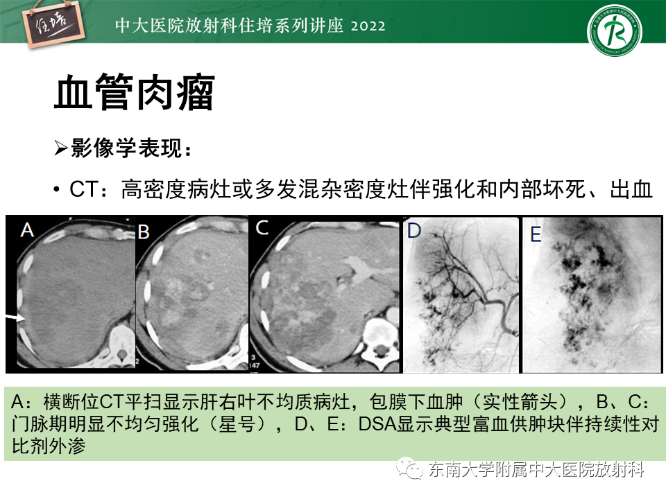 影像PPT - 【PPT】肝脏出血性病变的影像诊断及鉴别诊断-53