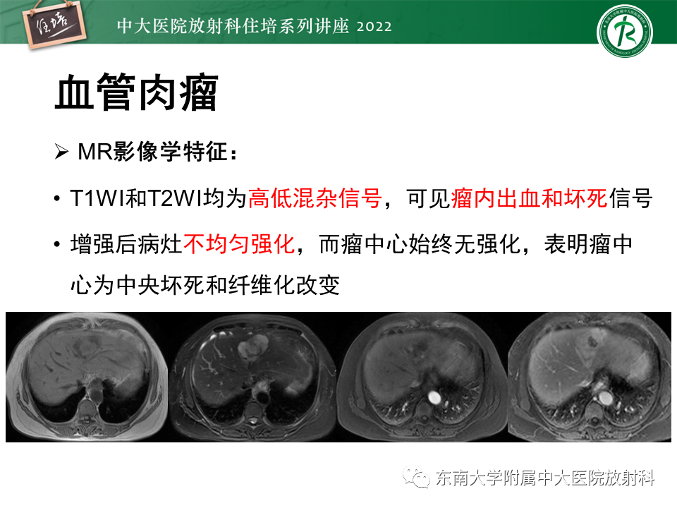 影像PPT - 【PPT】肝脏出血性病变的影像诊断及鉴别诊断-54