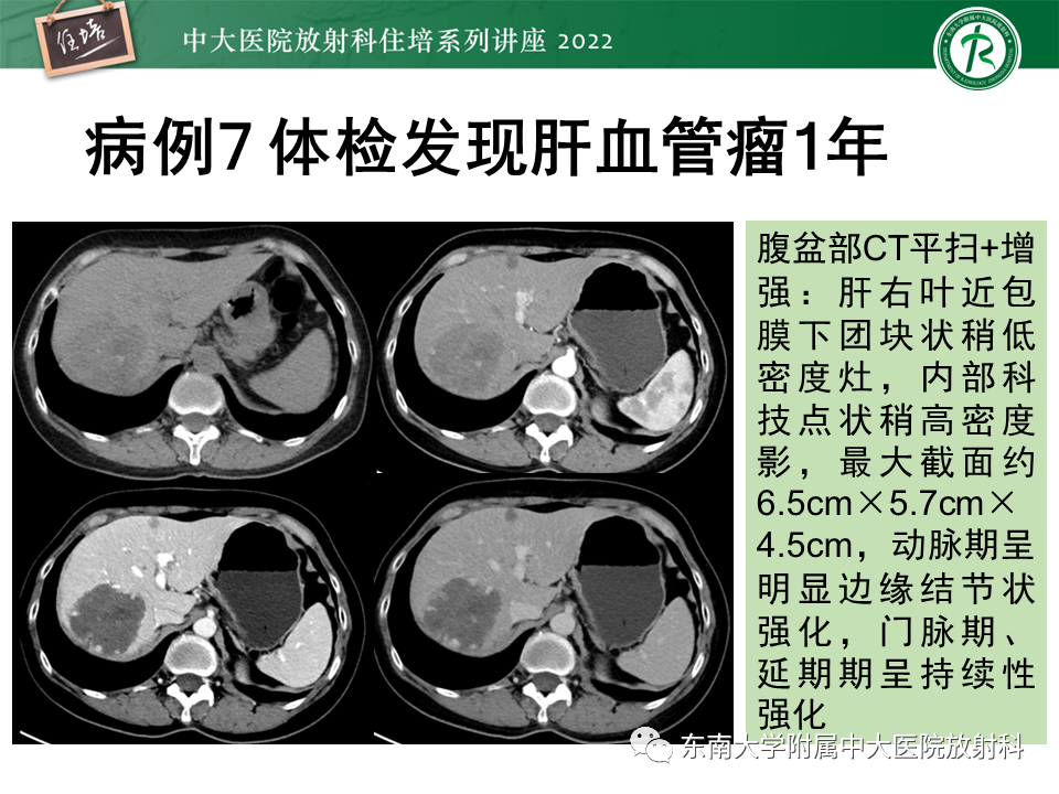 影像PPT - 【PPT】肝脏出血性病变的影像诊断及鉴别诊断-58